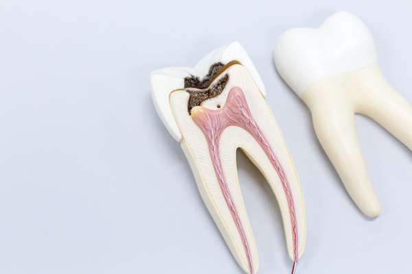 Ask a General Dentist: Is a Tooth Dead After a Root Canal from Dental 32 in Phoenix, AZ