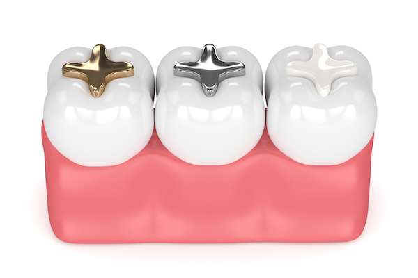 A General Dentist Discusses Different Filling Options from Dental 32 in Phoenix, AZ